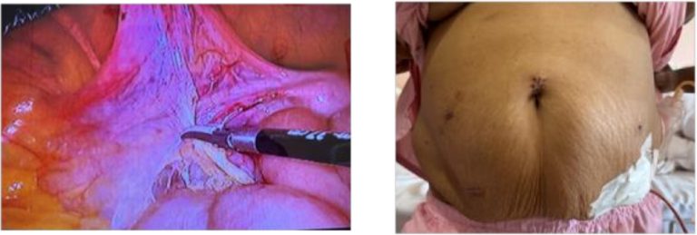 3 Interesting Cases Operated at Jharkhand Cancer Centre